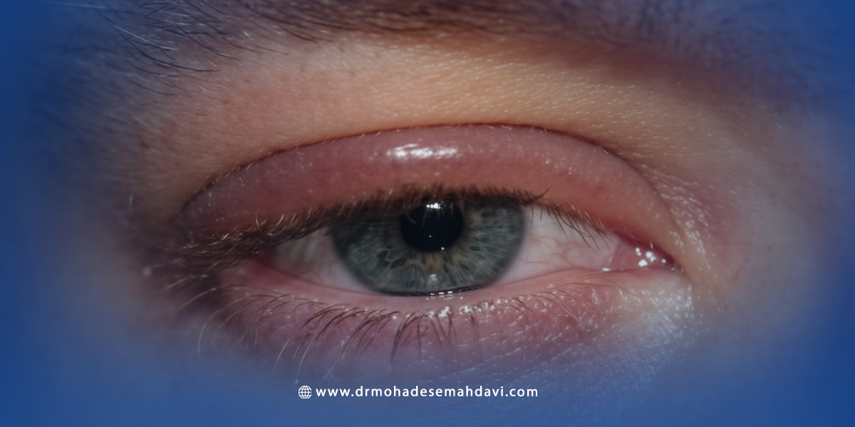 انواع آلرژی چشمی