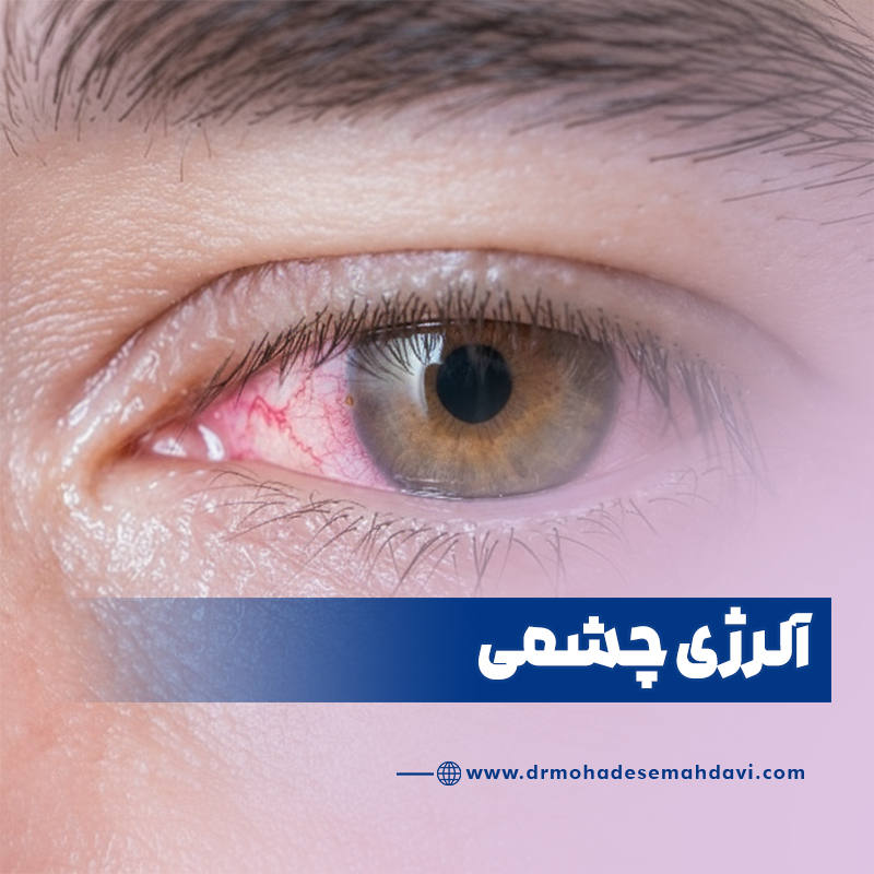 آلرژی چشمی چیست؟